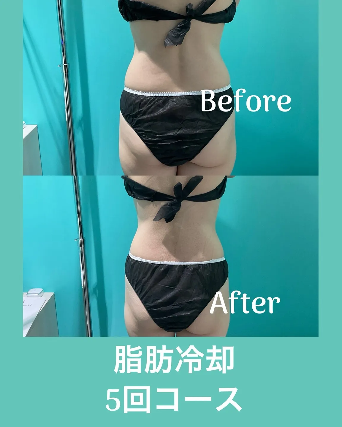 脂肪冷却5回コース
